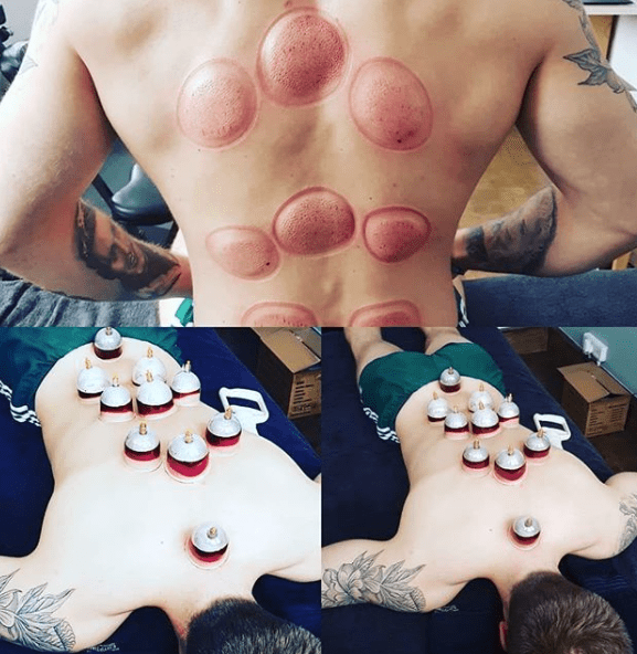 Does Wet Cupping Work
